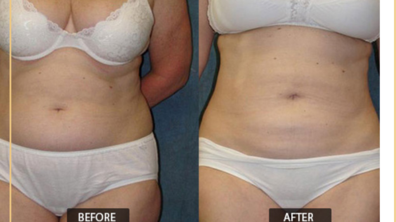 Does non surgical liposuction work?
