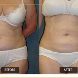 Does non surgical liposuction work?