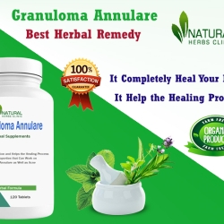 Simple, Easy-to-Make Granuloma Annulare Home Remedies