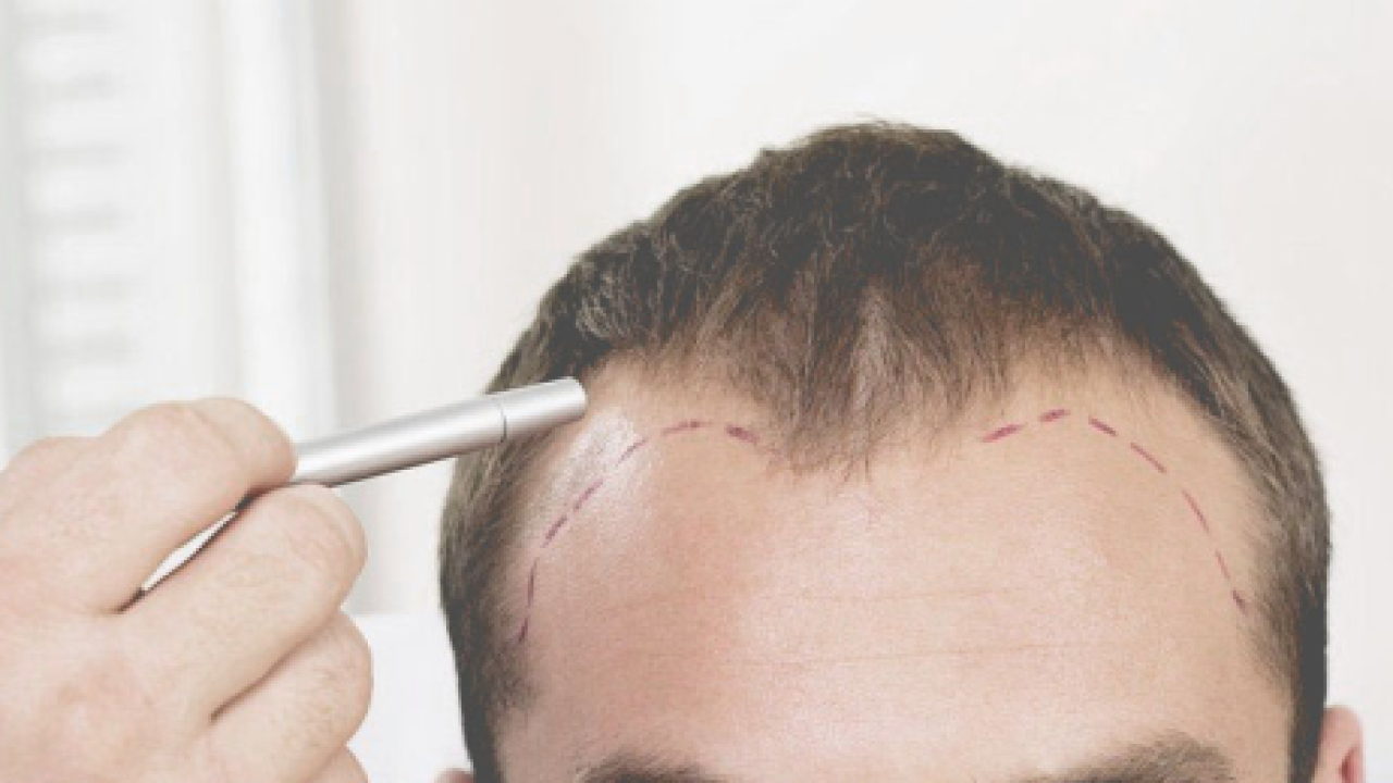 Hair Transplant Innovations: Stem Cell Therapy and B