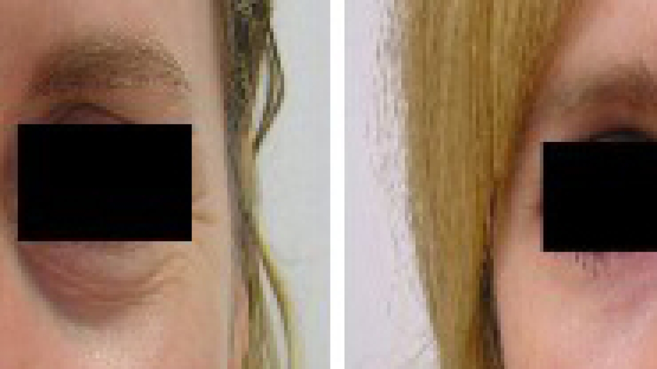 Muscat's Eyelid Surgery Trends: What's Hot and What's Not