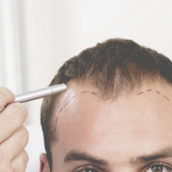 Hair Transplant Innovations: Stem Cell Therapy and B