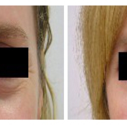 Muscat's Eyelid Surgery Trends: What's Hot and What's Not