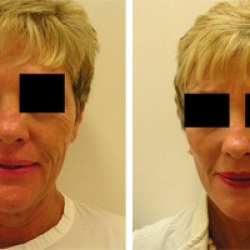 The Ultimate Guide to Facelift Surgery: What You Need to Know