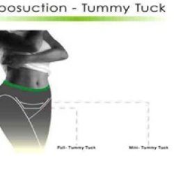 How Tummy Tuck Costs Have Changed Over the Years