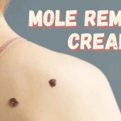 How to Choose the Best Mole Removal Cream